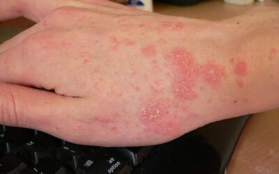 Výskyt svrabu v základní škole